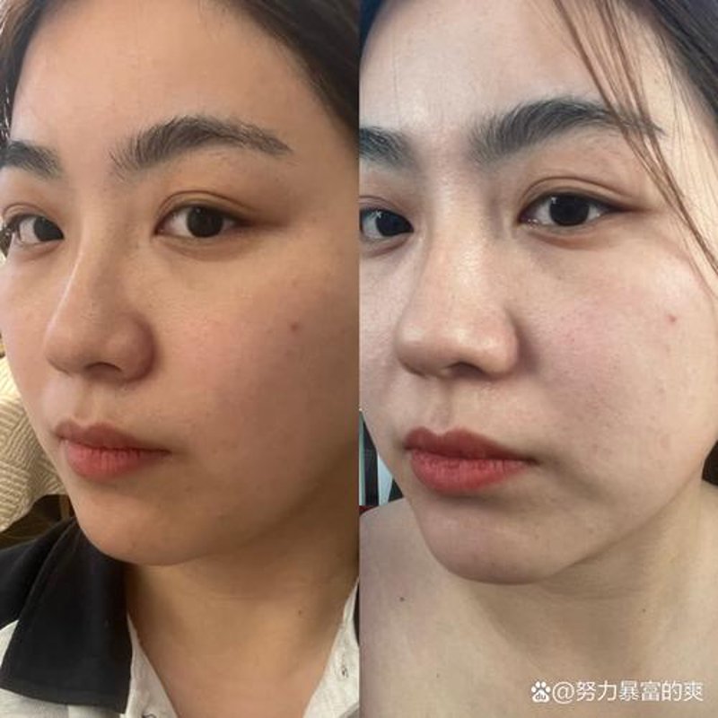 光子嫩肤：用科技给肌肤一次全新的升级